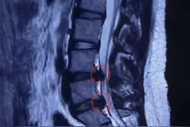13岁女孩患腰椎间盘突出症，医生“复盘”发病原因，这两点要注意图片