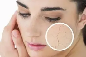 皮肤干燥病易致！牢记三个保湿技巧，筑牢皮肤屏障图片