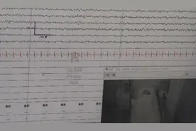 女孩48秒睡着、大笑就晕倒，竟是因为有“睡美人”基因图片