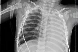 1岁宝宝发热一天就病危，左肺全白！医生发现肺部长出神奇“树根”图片