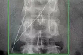 因和女友吵架，小伙赌气吞下两根钢丝图片