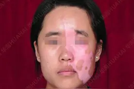 白癜风康复故事：山东“励志妹”用磨难成就多彩人生图片