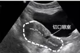 最长20天！年轻女子月经紊乱苦不堪言，原来是子宫上多了个“小房间”图片