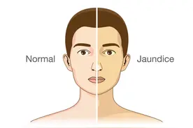 脸上出现4个变化，说明肝肾出大事了！其中1个还是肝癌信号，照照镜子就能发现图片
