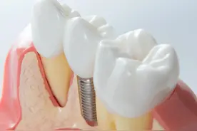 “人的第三副牙齿”种植牙究竟贵在哪？图片