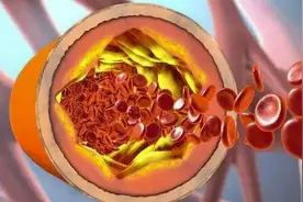 高血脂一直降不下来怎么办？医生：这4种食物需忌口图片