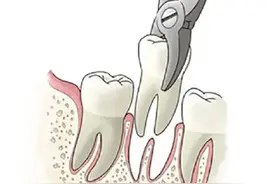 不是所有松动的牙齿都要被拔掉图片