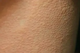 洗澡、运动后身上容易痒？可能是它惹的祸图片