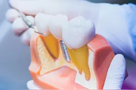 种植牙纳入医保支付范围？国家医保局答复来了图片