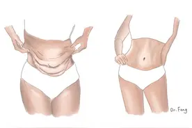 产后肚子怎么都瘦不回来？小心是这个问题图片