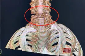 八旬老人摔倒后颈椎骨折，专家团队冒险手术复位图片