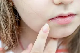 每个秋冬“烂嘴角”的人，该反思下这8件事了图片