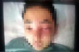 只因这个动作，湖南13岁男生患上脑膜炎，你可能也干过图片