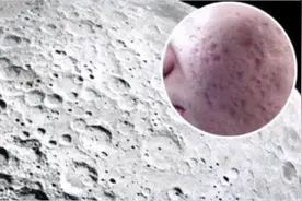 【康复园地】如何告别“月球脸”图片