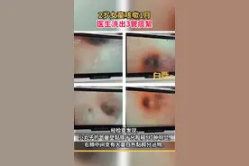 你喝的奶茶里到底有些什么？西安2岁女童喝奶茶咳嗽1月医生洗出3管痰絮图片