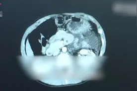 男童骑自行车下楼梯撞到腹部致胰腺断裂视频封面