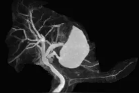 六旬老人反复腹痛持续半年，医生果断论证确定罕见病灶图片
