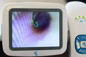 杭州女子突发耳鸣，医生从她耳中取出一根绿毛图片