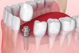 社区里也能种植牙啦！种牙安全吗？有哪些流程？图片