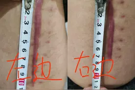 男孩右腿植骨左腿被误割10公分 医院：建议走司法鉴定赔偿金额图片