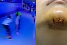 肇事者已找到！女生溜冰被人推倒下巴缝十多针：要求赔偿3万，他没有理解女生脸上有疤的问题视频封面