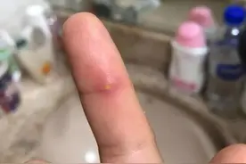 听说被海鲜扎伤会丢掉性命，但没想到死神差点找上我……图片