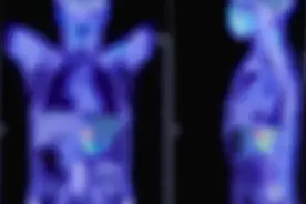 3个月前出现不明原因腹痛竟是腹膜后肿瘤！西京医院创新切除术进行根治图片