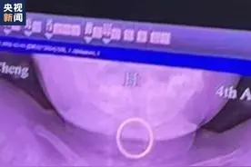 幼童误吞戒指卡喉，医生一招取出图片