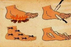 麻、痛、凉、痿！15年老“糖友”出现周围神经病变图片