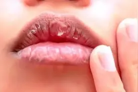 冬季嘴唇干裂、起皮？别再舔了图片