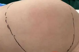 四个月女婴腹中藏有2斤重“怪胎”，里面有皮肤和头发图片