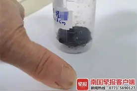 80岁医生给92岁病人取结石，这场“172岁”的手术太励志图片