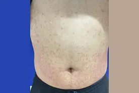 杭州小伙阳了之后吃了布洛芬，结果身上痒出现皮疹是什么情况？别慌，听医生说说图片