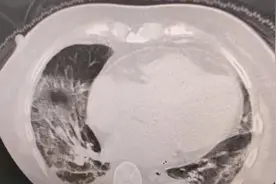 没发烧不咳嗽，一查双肺都白了！这些阳性患者做个CT很有必要图片