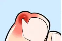 小伙患甲沟炎拖了七八年！指甲究竟剪平还是剪圆？图片