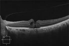 陕西中医药大学第二附属医院：黄斑裂孔知多少？图片