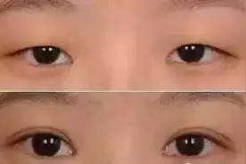 济南海峡整形分享：双眼皮术后这样做恢复更快！图片