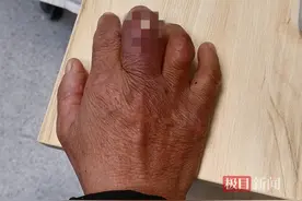 爹爹手指长痛风石十多年，致手部关节严重变形图片