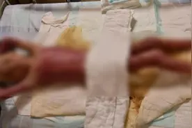 心痛！妈妈离家出走，6岁男孩帮瘫痪爸爸做饭致重度烧伤图片