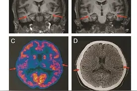 19岁男孩被诊为阿尔兹海默症图片