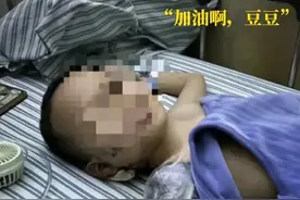 被炮仗炸伤截肢的男孩：体内残留碎片完全清除或需两三年图片