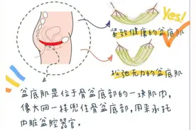 重视凯格尔练习，有效恢复盆底肌图片