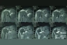 赤峰市第二医院成功施行关节镜下背阔肌腱转位术治疗巨大肩袖撕裂手术图片