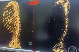 缺钙有多严重？男子在CT图像中没有肋骨“像一个透明人”图片