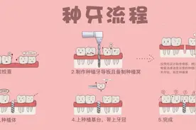 种植牙价格更“亲民”，但这些流程必知晓！图片
