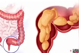 大便出血……是痔疮还是癌症？简单几点，教你辨别！图片