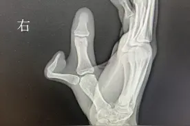 “以后我再也不怕和别人握手了”， “六指男孩”成功截指解开18年心结图片