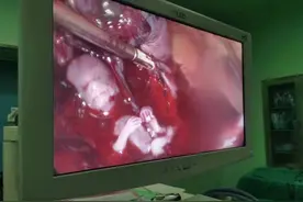 生死时速！“宫外孕”出血2400毫升，清远妇幼成功抢救图片