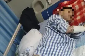 10岁脑瘫男孩烤火时严重烧伤，家属：正为巨额医疗费发愁图片