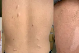 协和医生说｜结节性硬化症——隐藏在体检报告单中的罕见病图片